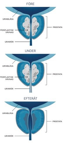 rezum -water vapor therapy